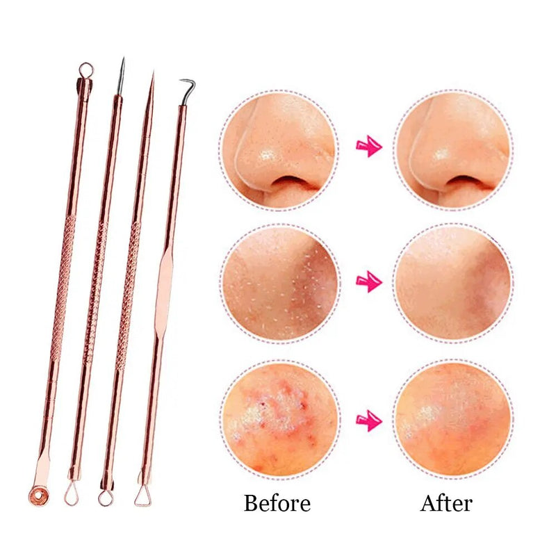 best blackhead removal kit  | Shopsglam